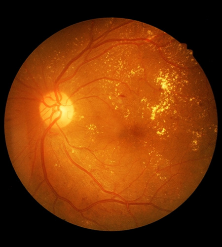 Diabetic Retinopathy
