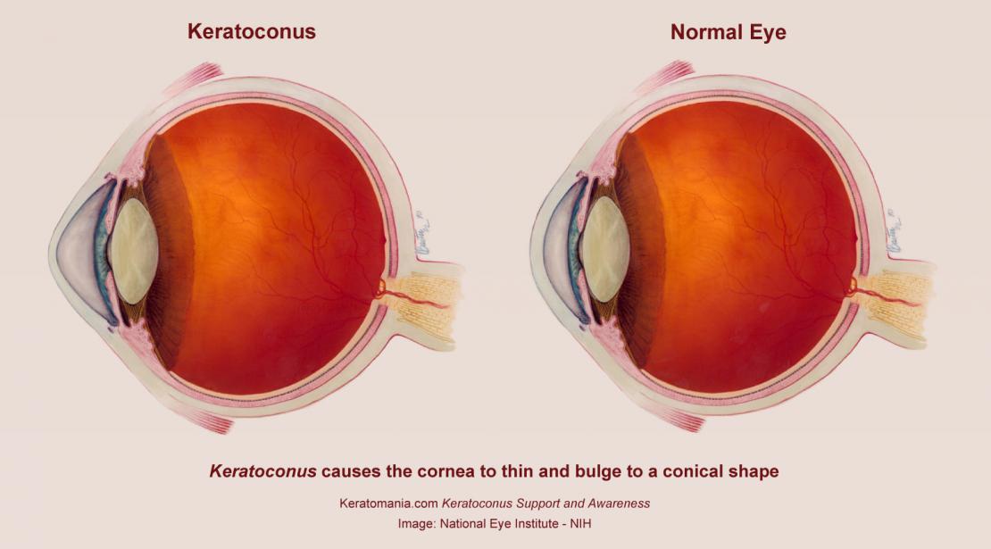 Keratoconus