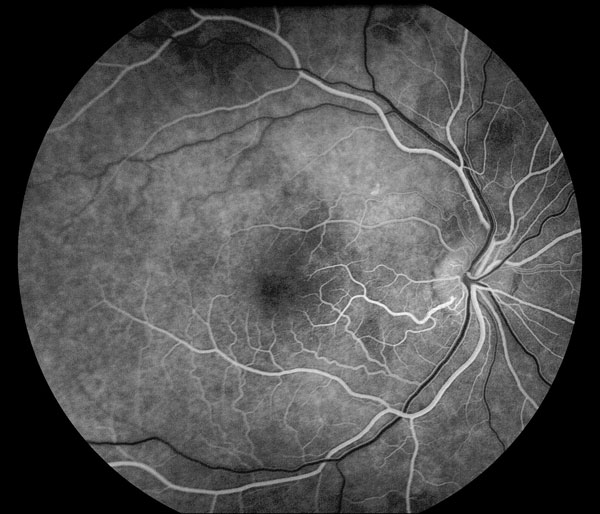 Diabetic Retinopathy