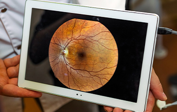 glaucoma