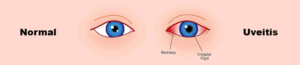uveitis