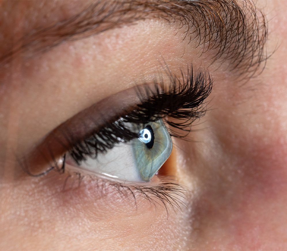 keratoconus
